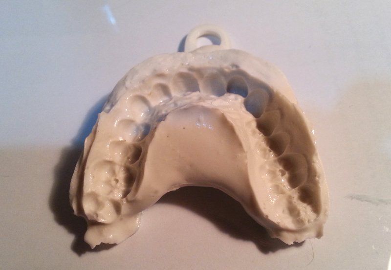 跟高价牙医说再见：男子用3D打印自制牙套