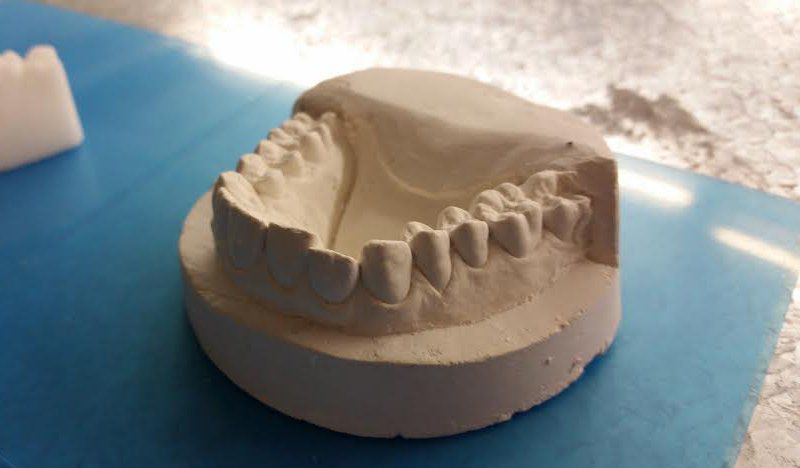 跟高价牙医说再见：男子用3D打印自制牙套