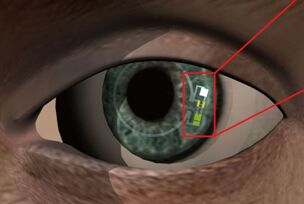 科学家正研发可检测血糖的隐形眼镜