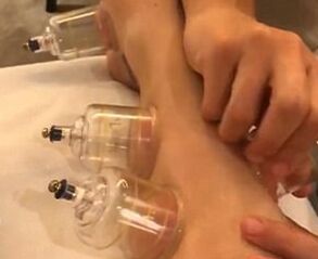 水果姐超爱拔罐！已经臣服在中国技术之下
